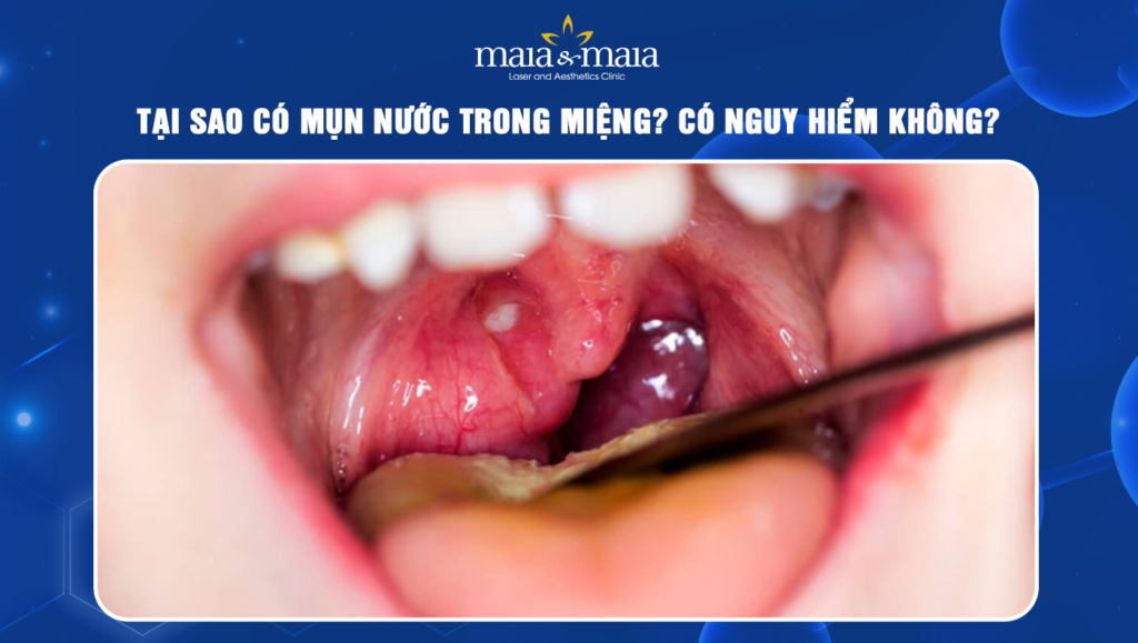 mụn nước trong miệng