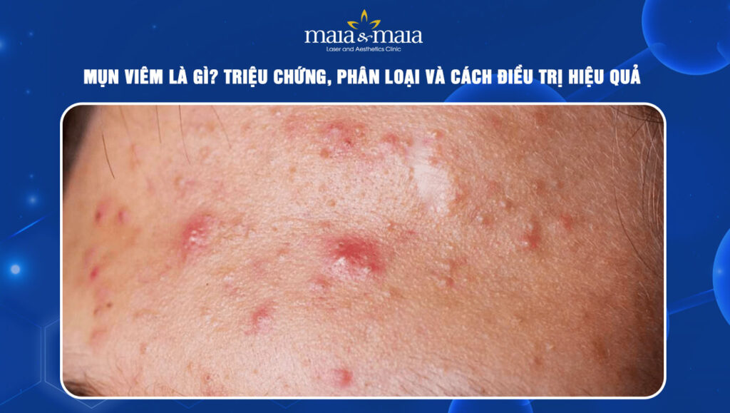 mụn viêm