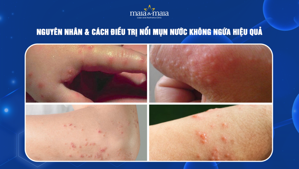 nổi mụn nước không ngứa