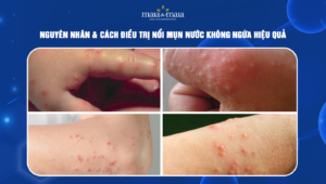 nổi mụn nước không ngứa
