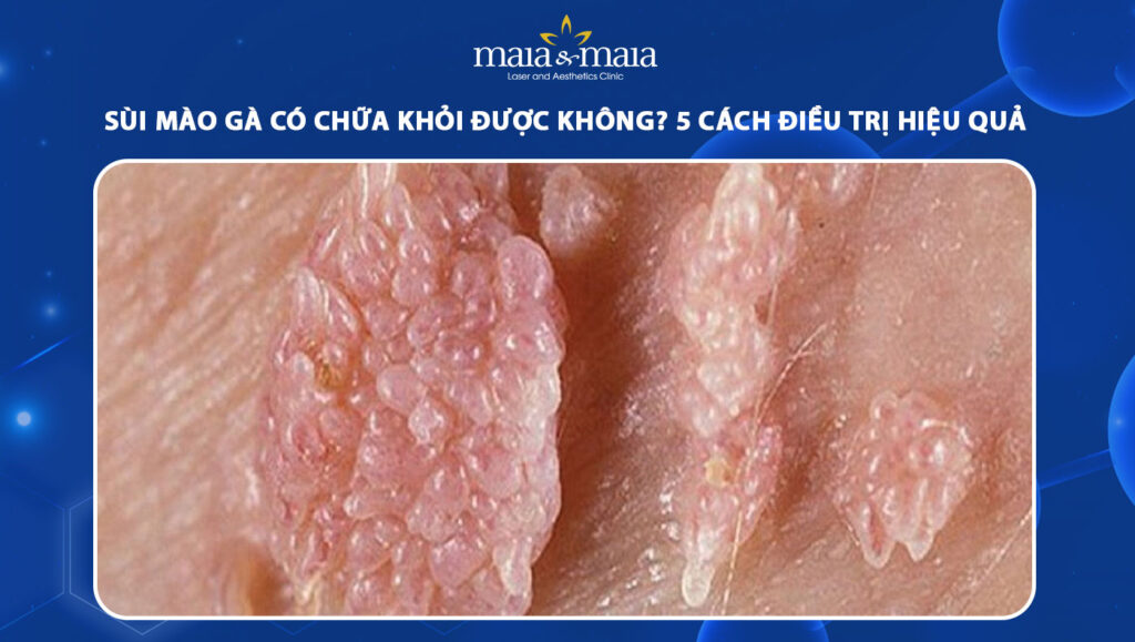 Sùi mào gà có chữa khỏi được không