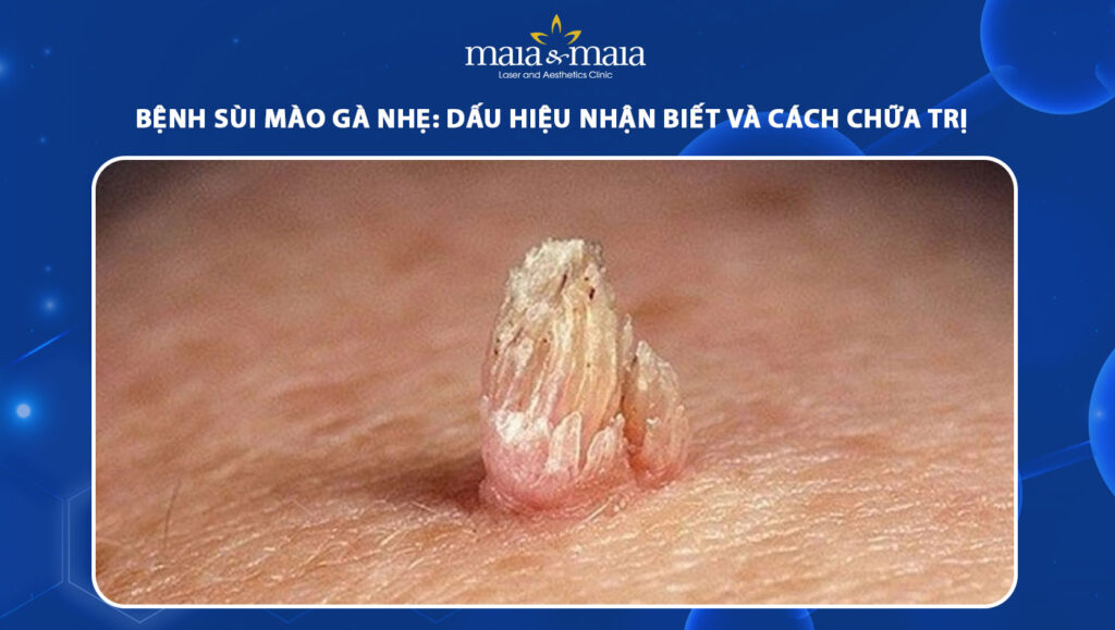 bệnh sùi mào gà nhẹ