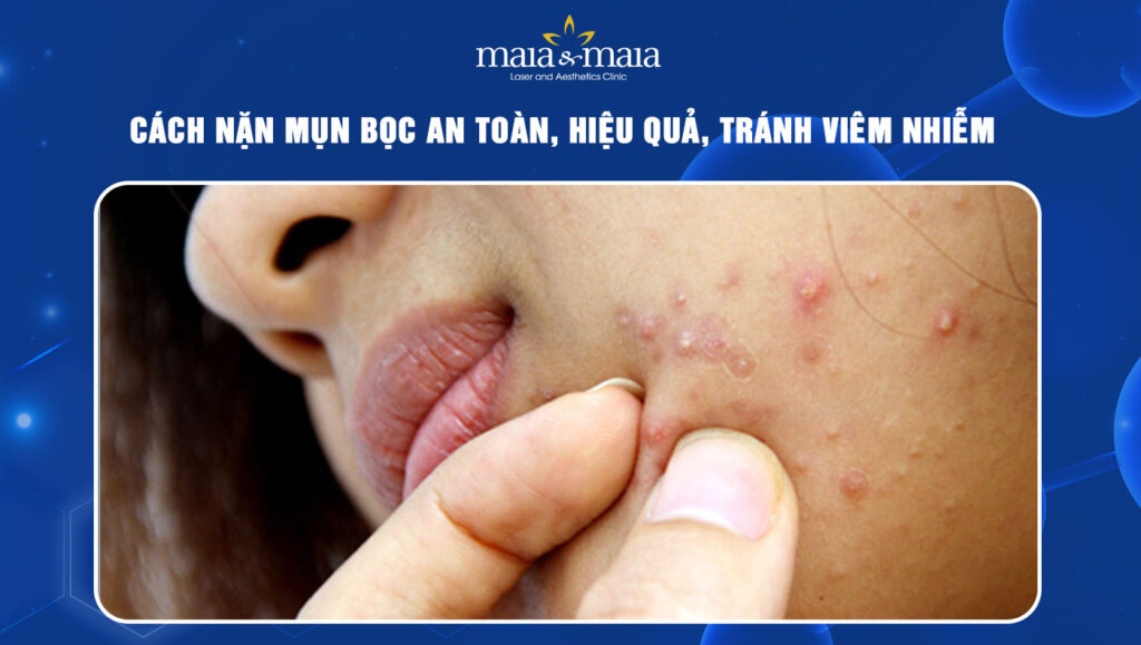 cách nặn mụn bọc