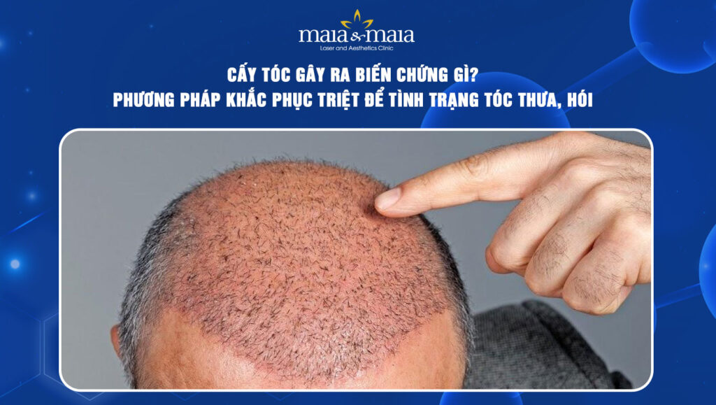 cấy tóc