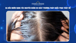 da đầu nhờn rụng tóc