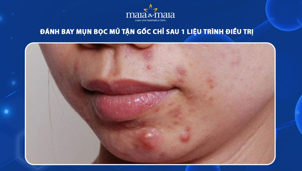 mụn bọc mủ