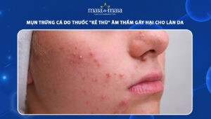 mụn trứng cá do thuốc