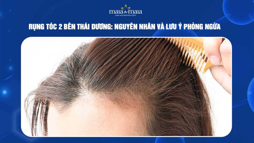 rụng tóc 2 bên thái dương