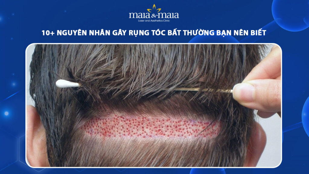 rụng tóc bất thường
