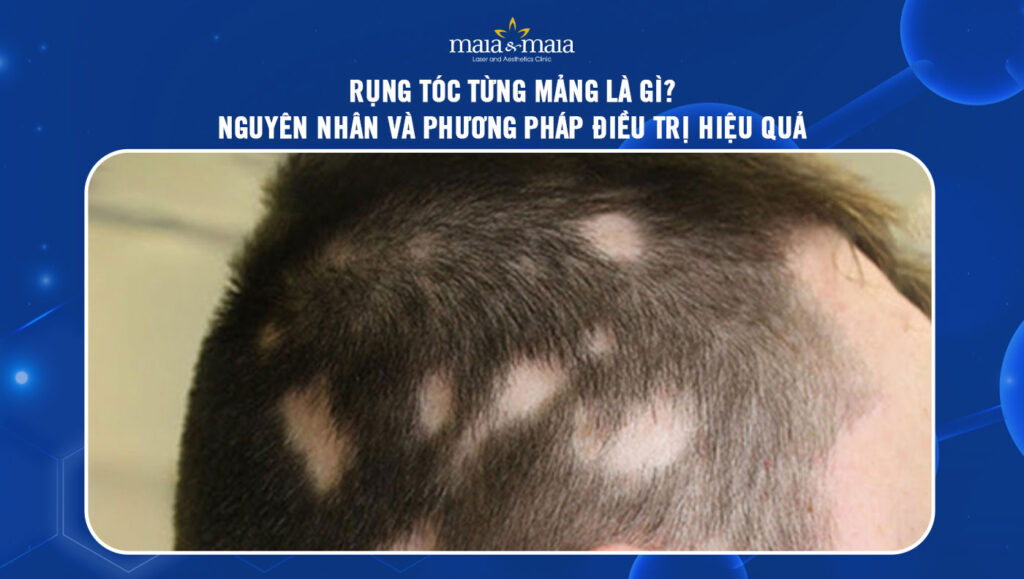 rụng tóc từng mảng