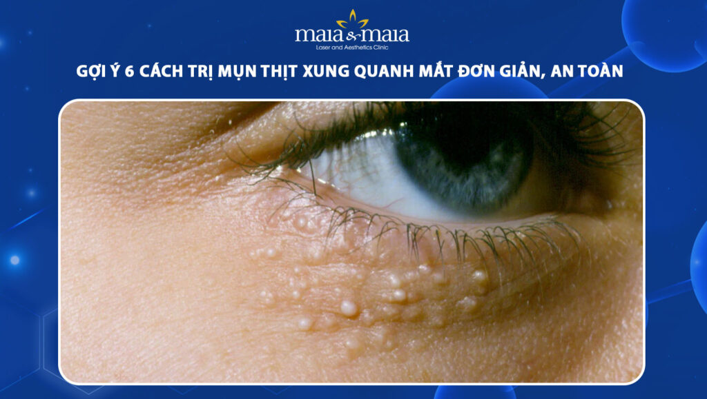 cách trị mụn thịt xung quanh mắt