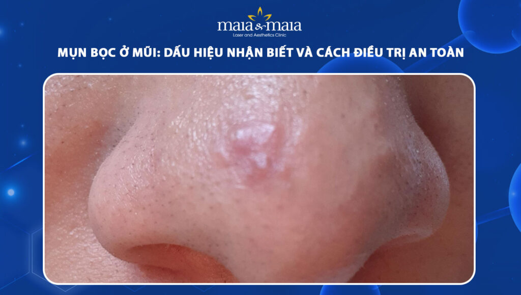 mụn bọc ở mũi