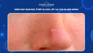 mụn bọc ở mũi bị chai