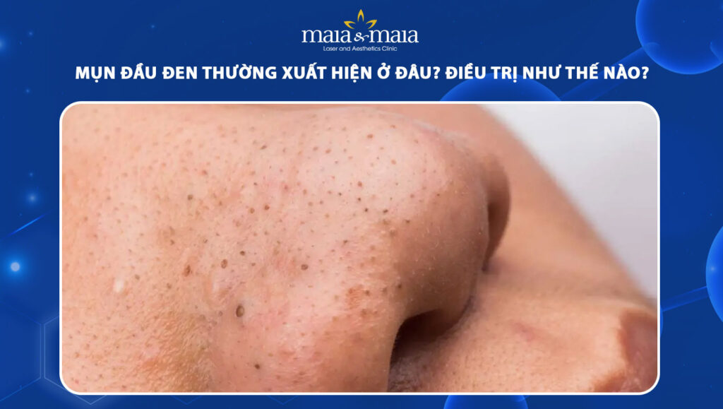 mụn đầu đen
