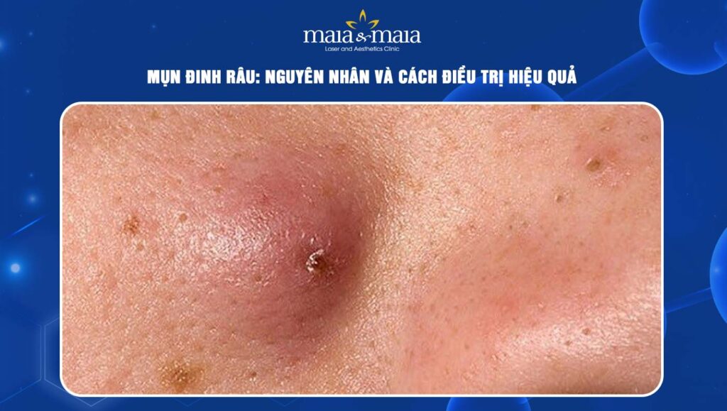 mụn đinh râu
