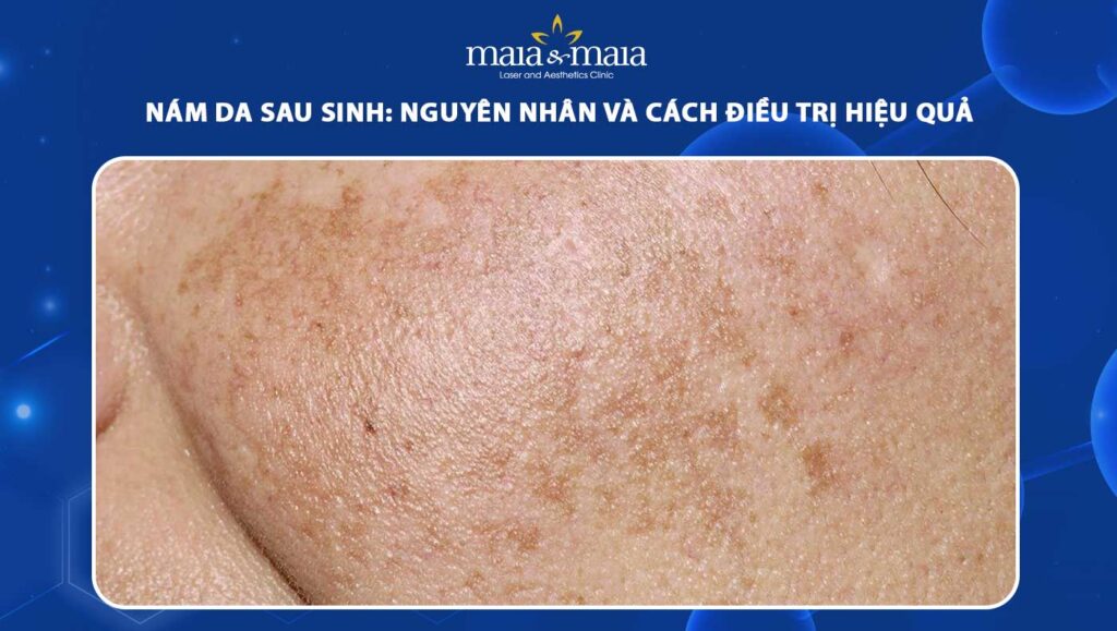 nám da sau sinh