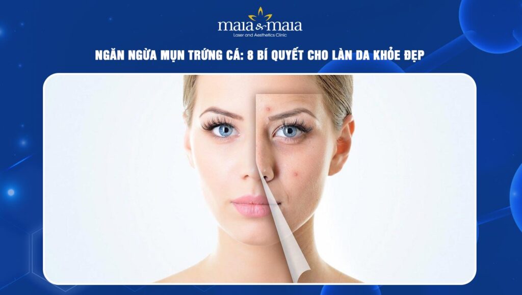 ngăn ngừa mụn trứng cá