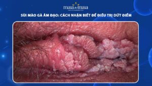 sùi mào gà âm đạo