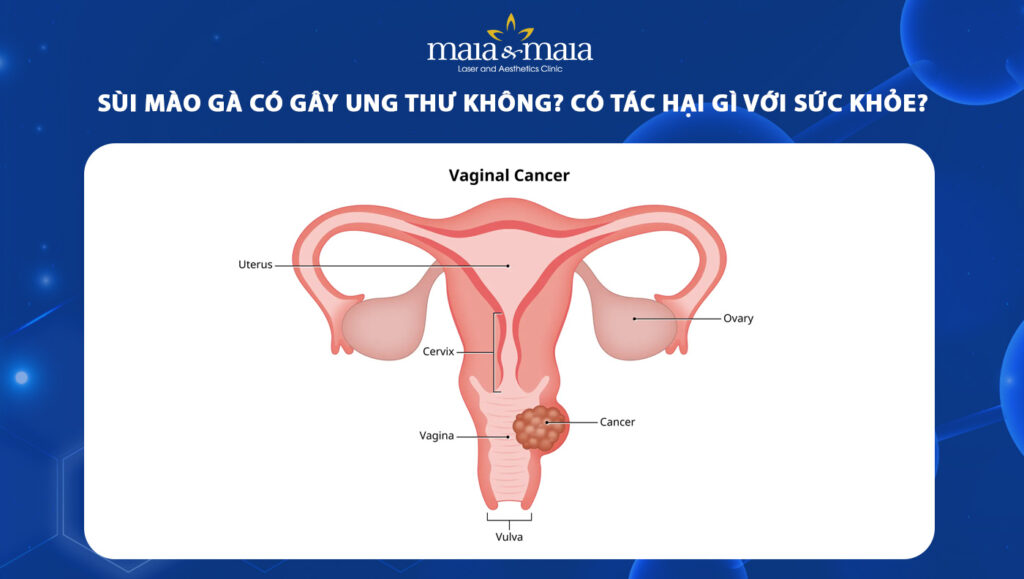 Sùi mào gà có gây ung thư không