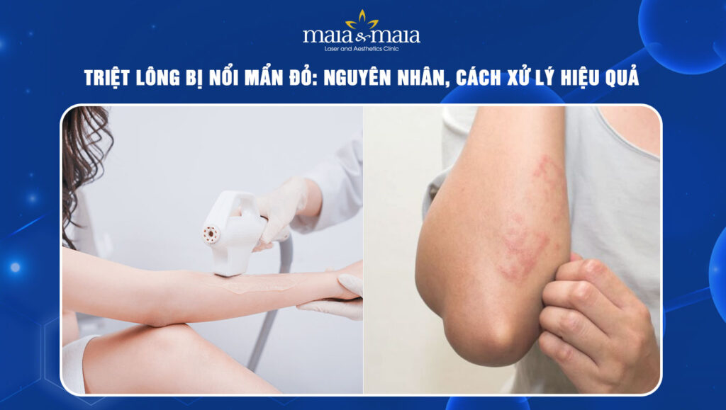 triệt lông bị nổi mẩn đỏ