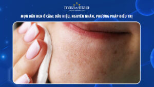 Mụn đầu đen ở cằm