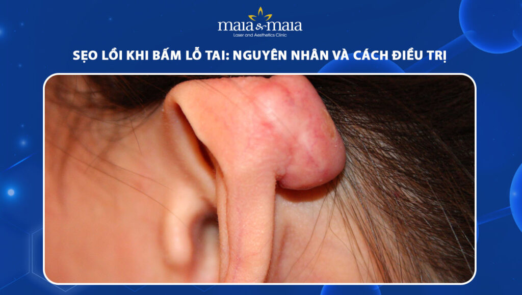 Sẹo lồi khi bấm lỗ tai