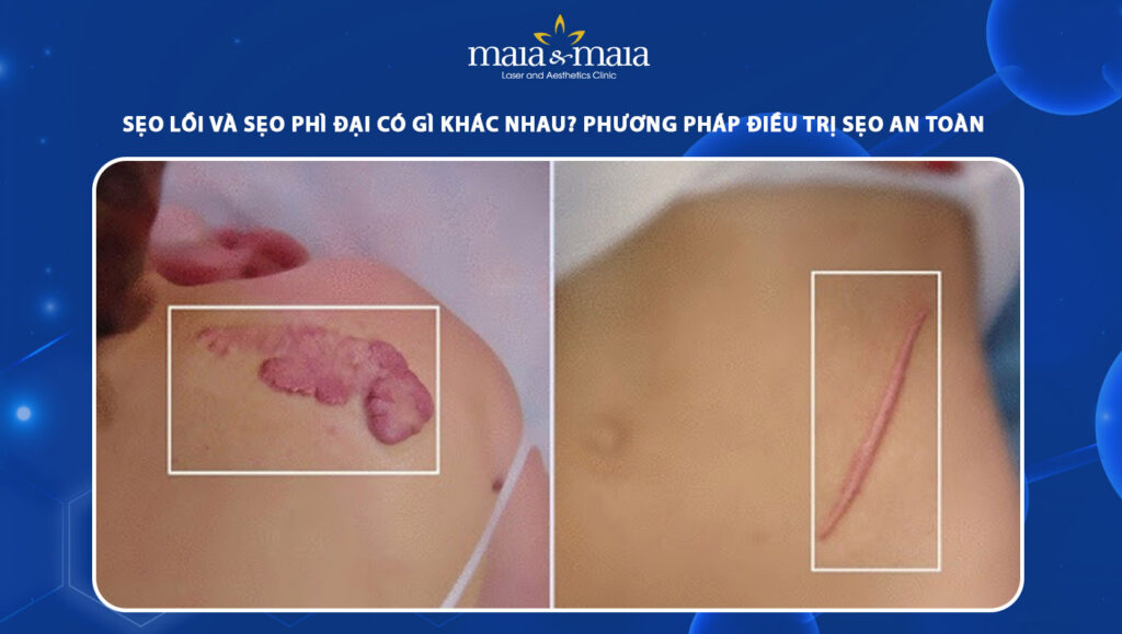 Sẹo lồi và sẹo phì đại