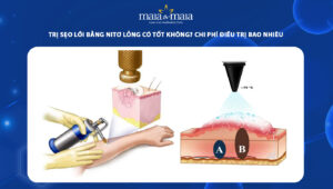 Trị sẹo lồi bằng nitơ lỏng