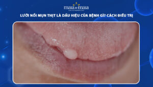 lưỡi nổi mụn thịt