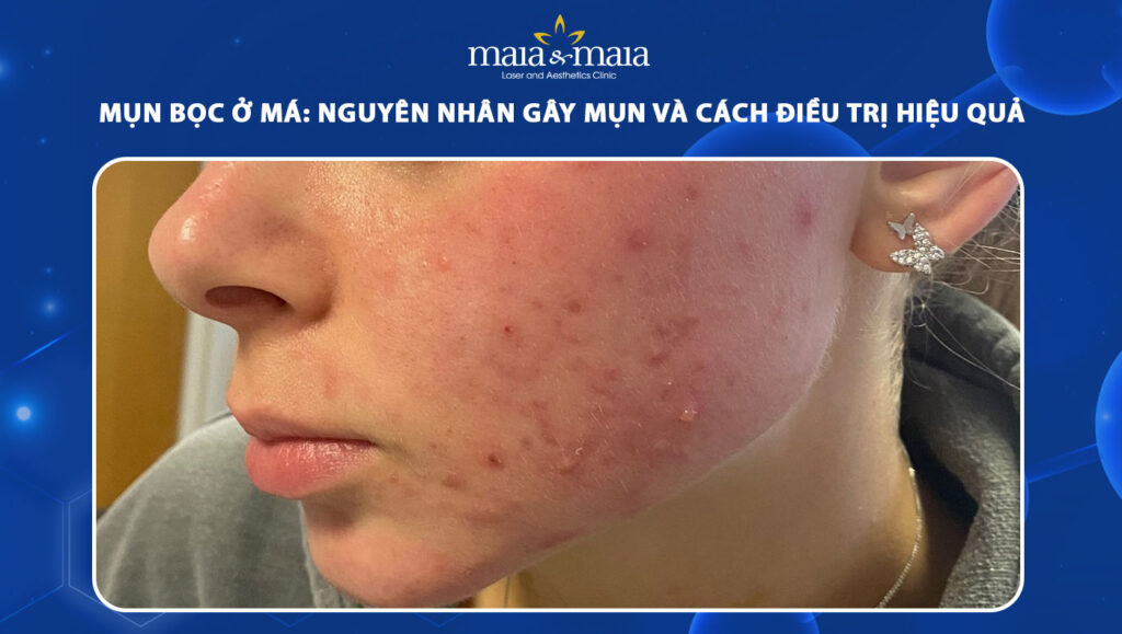 mụn bọc ở má
