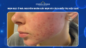 mụn bọc ở má