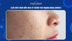 mụn đầu đen có thành tàn nhang