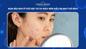 mụn đầu đen ở tuổi dậy thì