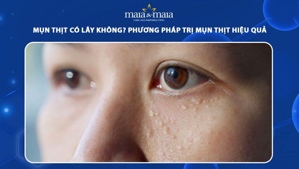 mụn thịt có lây không