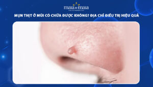 mụn thịt ở mũi