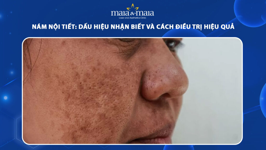 nám nội tiết