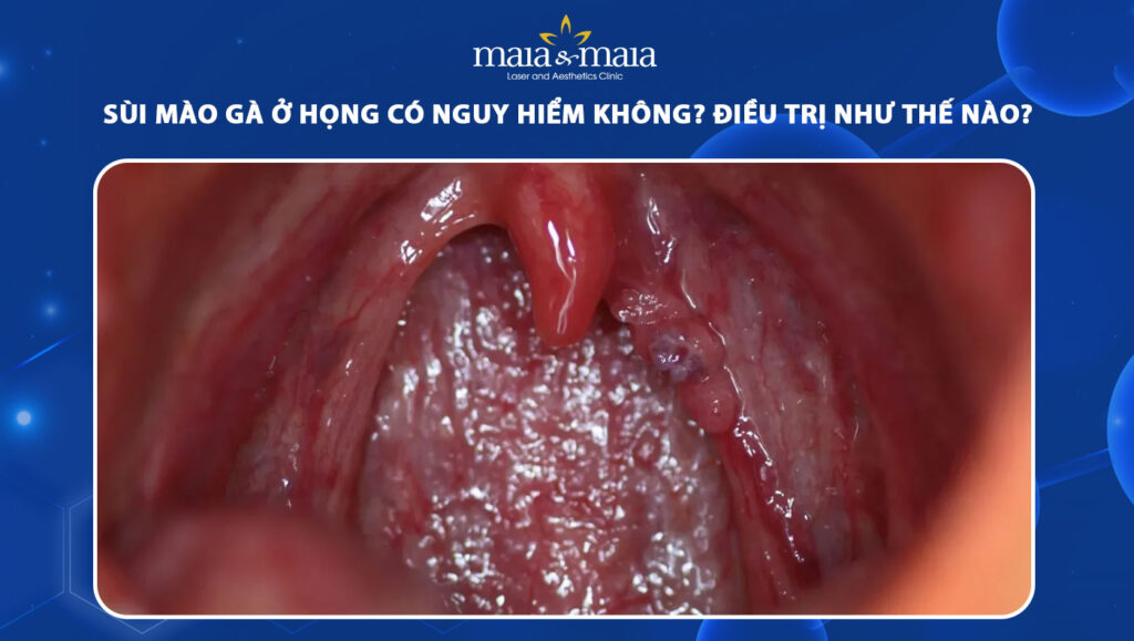 sùi mào gà ở họng