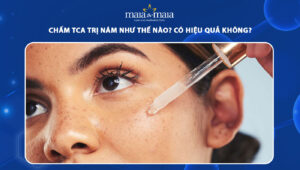 chấm tca trị nám