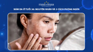 nám da ở tuổi 30