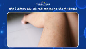 nám ở chân
