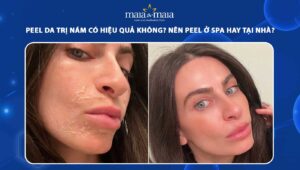 peel da trị nám