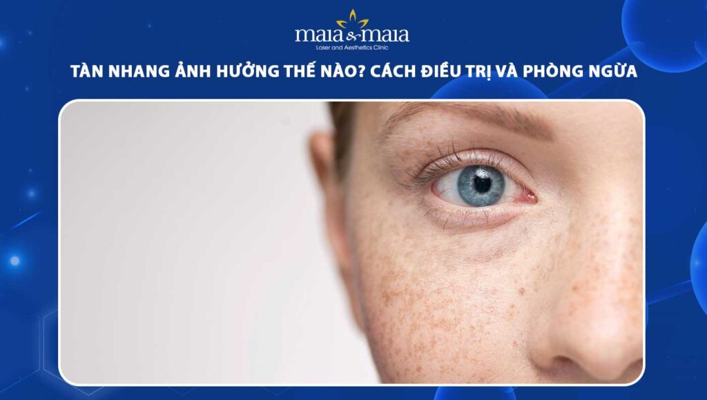 tàn nhang