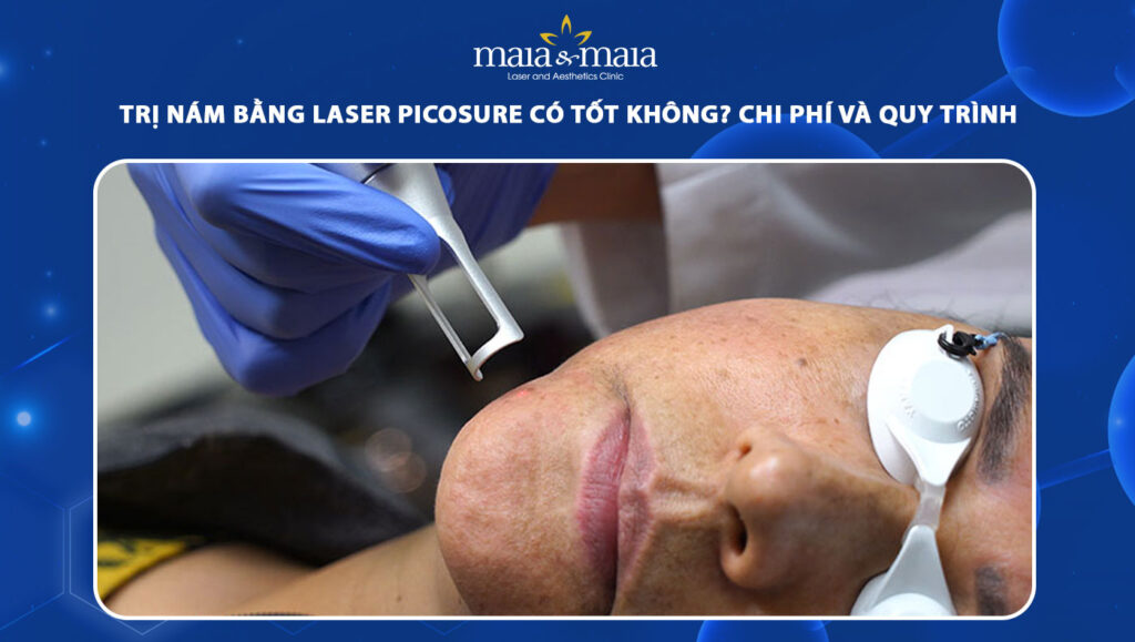 trị nám bằng laser picosure