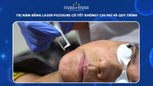 trị nám bằng laser picosure
