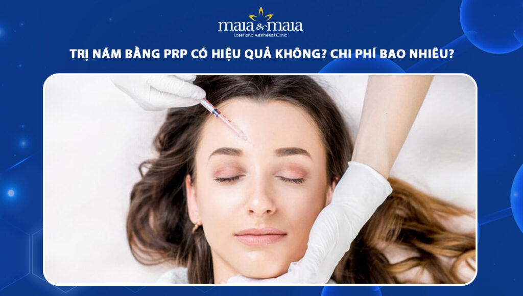 trị nám bằng prp