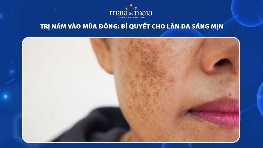 trị nám vào mùa đông