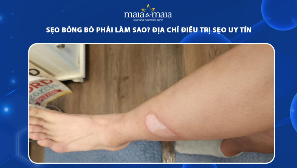 sẹo bỏng bô