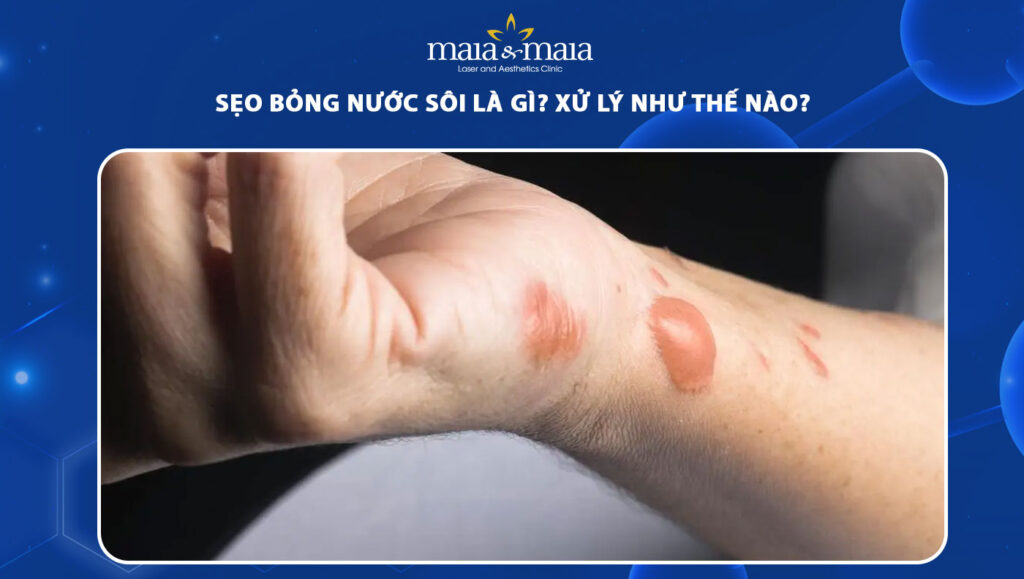 sẹo bỏng nước sôi