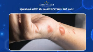 sẹo bỏng nước sôi