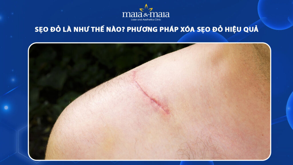 sẹo đỏ